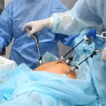 اسلیو معده با لاپاراسکوپی