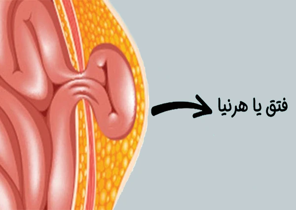 عمل فتق شکم در تهران