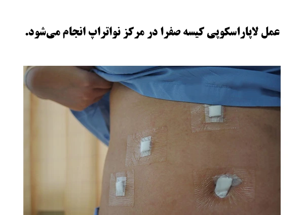 عمل لاپاراسکوپی کیسه صفرا
