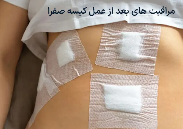 مراقبت های بعد از عمل کیسه صفرا