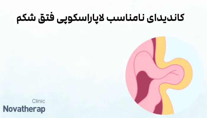 کاندیدای نامناسب لاپاراسکوپی فتق شکم