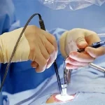 فرق لاپاراسکوپی و جراحی باز