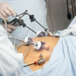 آمادگی قبل از عمل اسلیو معده با لاپاراسکوپی