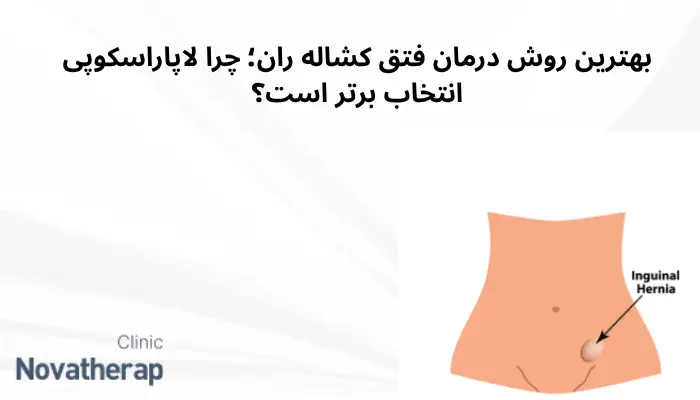 بهترین روش درمان فتق کشاله ران؛ چرا لاپاراسکوپی انتخاب برتر است؟ بهترین روش درمان فتق کشاله ران؛ چرا لاپاراسکوپی انتخاب برتر است؟
